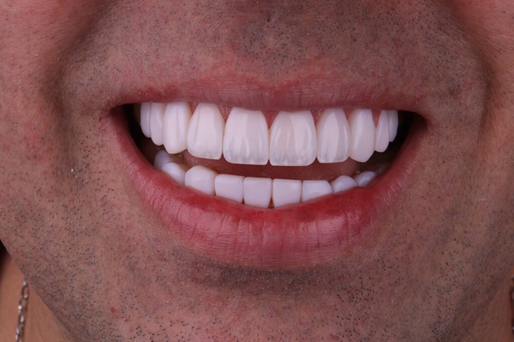 homem sorrindo com lestes estratificadas realistas gold smile